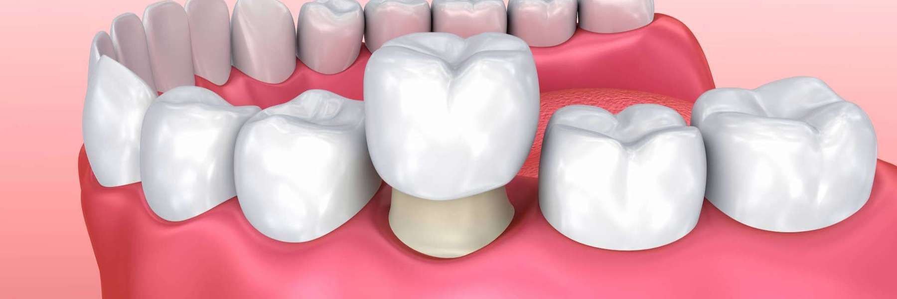 Illustration of a dental crown placement, one of the 5 Dental Treatments in El Dorado Hills.