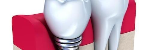 dental implant graphic