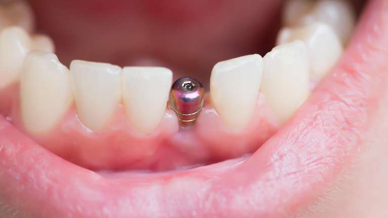 dental implants el dorado hills