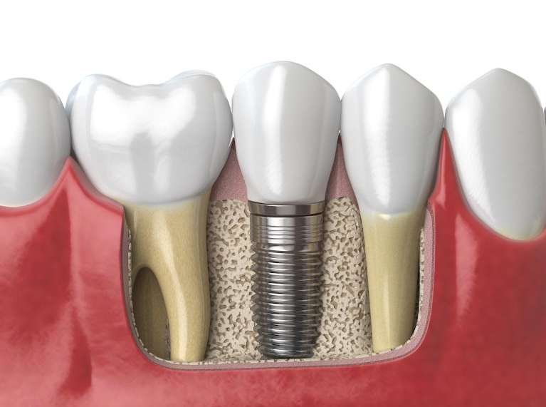 What to Expect during the Dental Implant Procedure