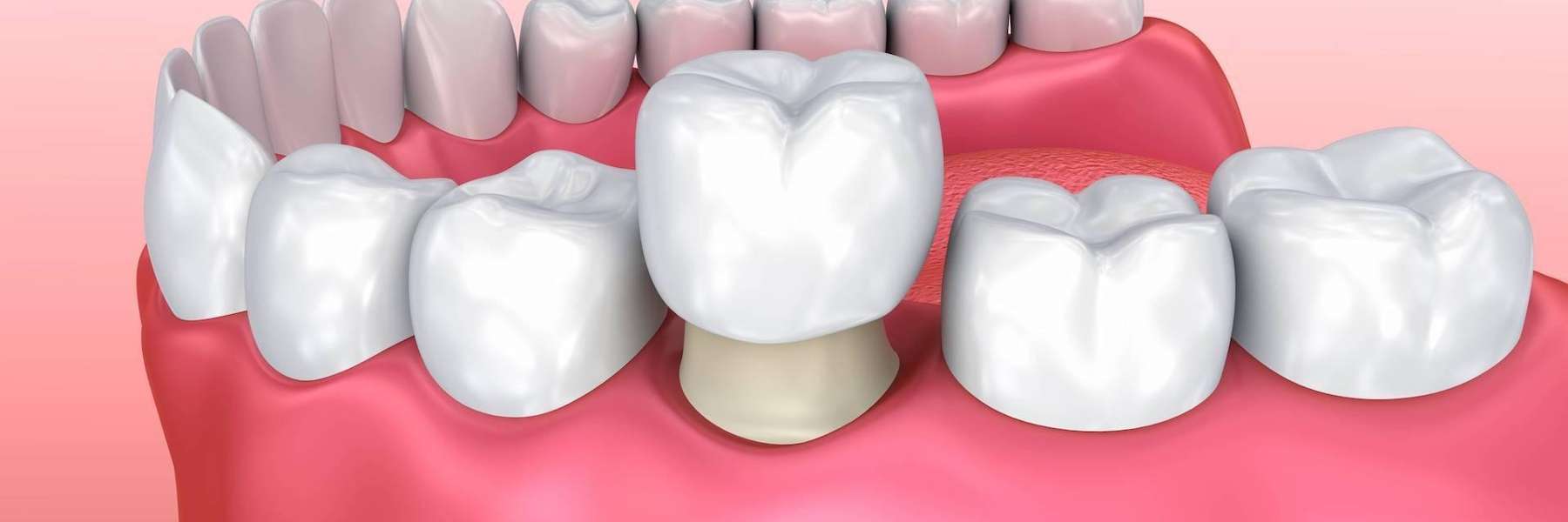 dental crowns illustration in El Dorado Hills