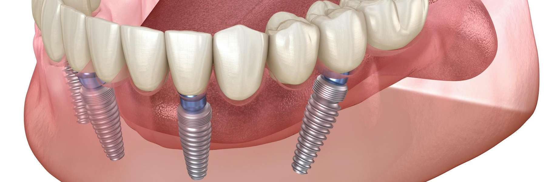 Dental implant illustration in El Dorado Hills