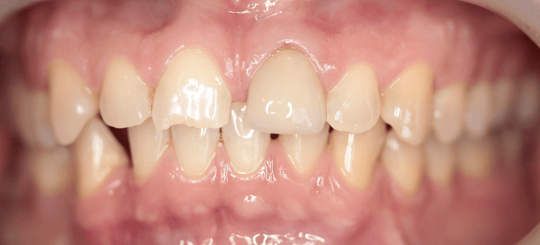 Crown-Restoration-After-Image