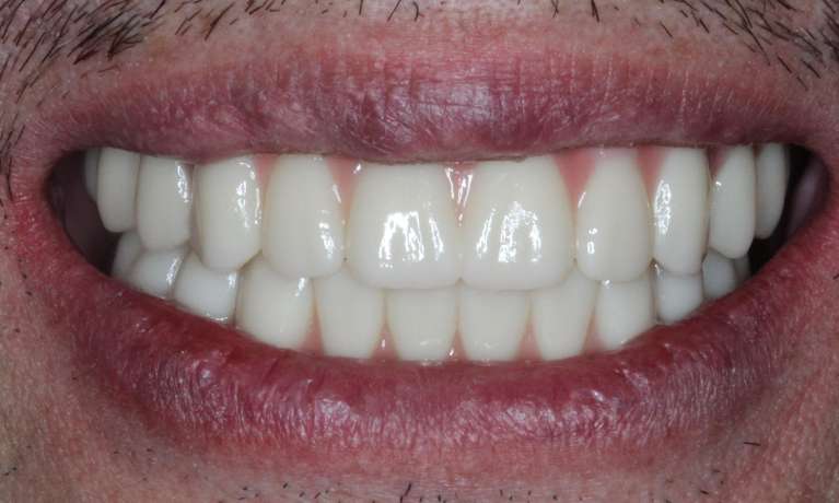 after dental implants