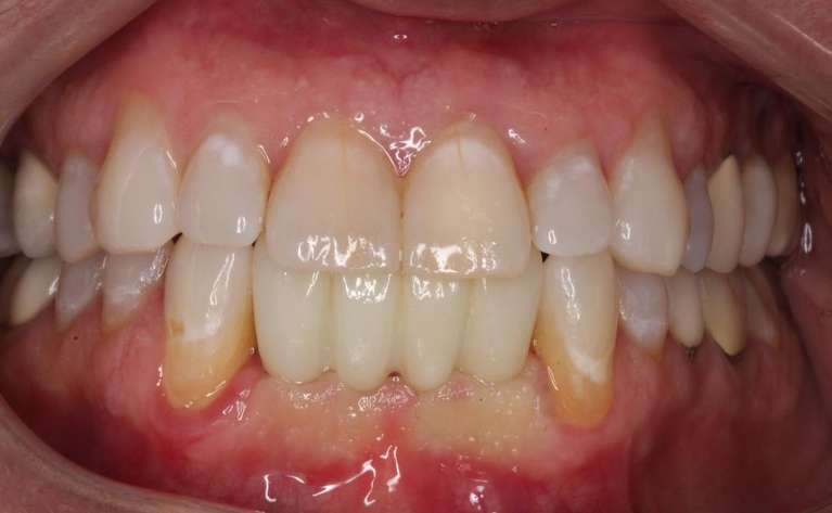 Implant-Bridge-After-Image