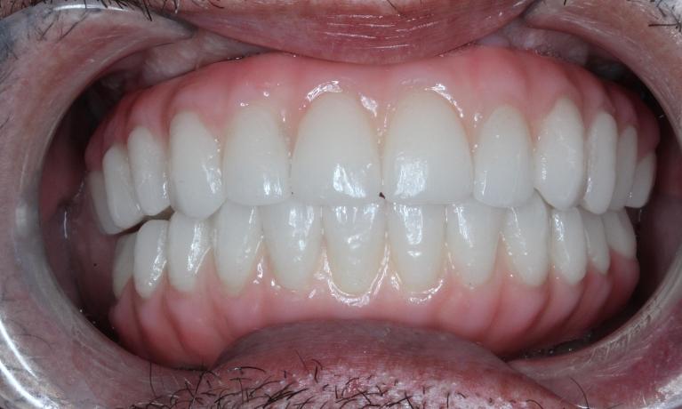 denture implant teeth after
