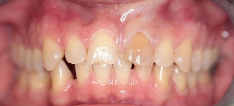 Crown-Restoration-Before-Image