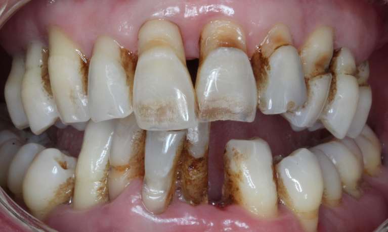 before dental implants