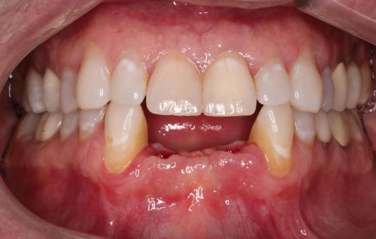 Implant-Bridge-Before-Image